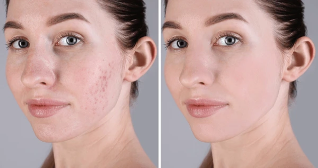 acne-problem-young-woman-before-600nw-2442701427 1