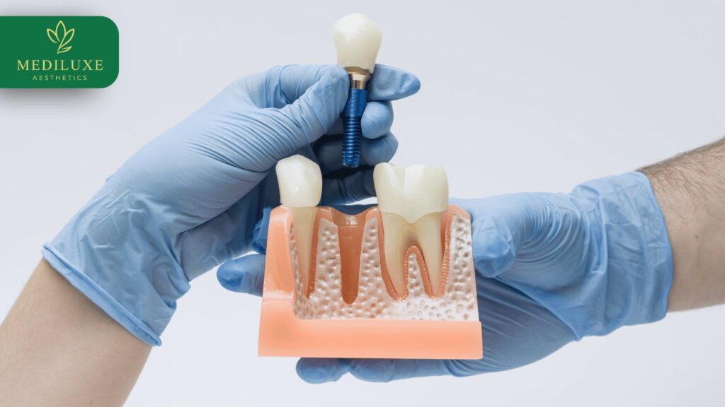 Best Dental Crown Treatment in Janakpuri