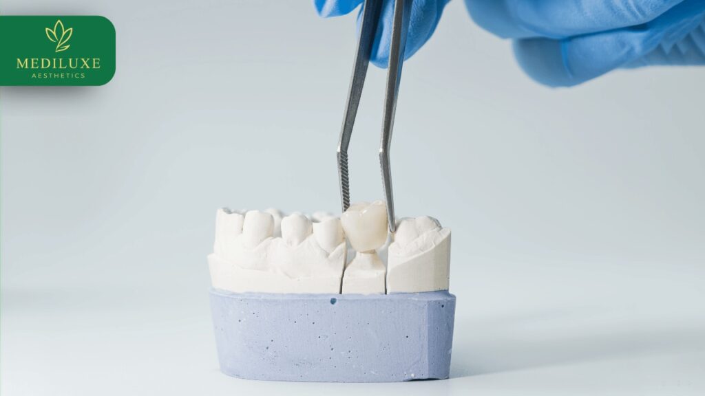 Best Dental Crown Treatment in Janakpuri