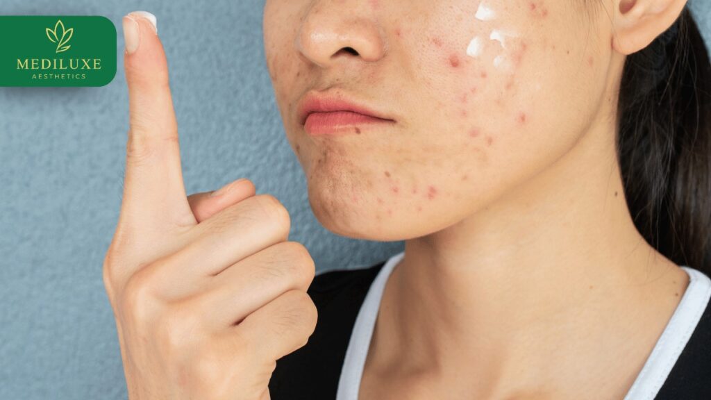 Best Acne & Acne Scar Treatment in Janakpuri