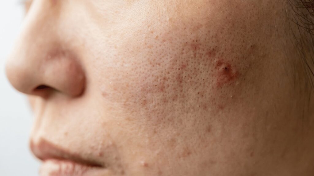 Acne & Acne Scar Treatment in Janakpuri