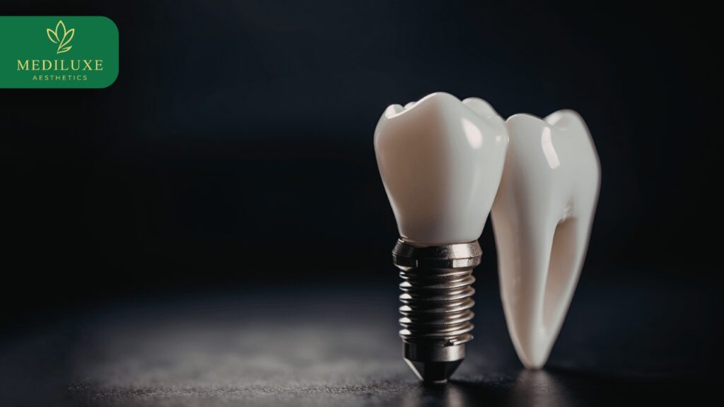 Best Dental Implants Treatment in Janakpuri