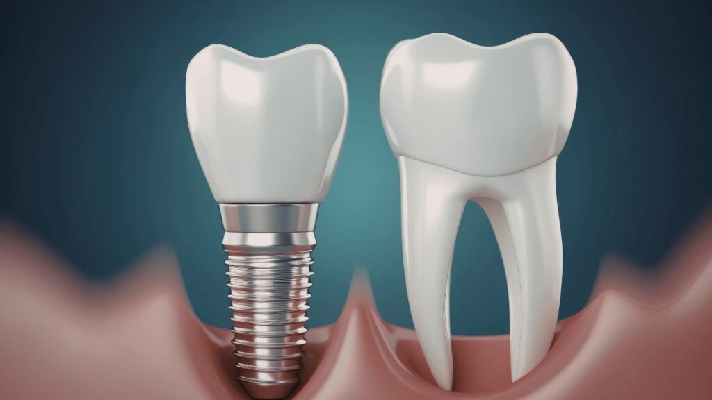 Dental Implants Treatment in Janakpuri