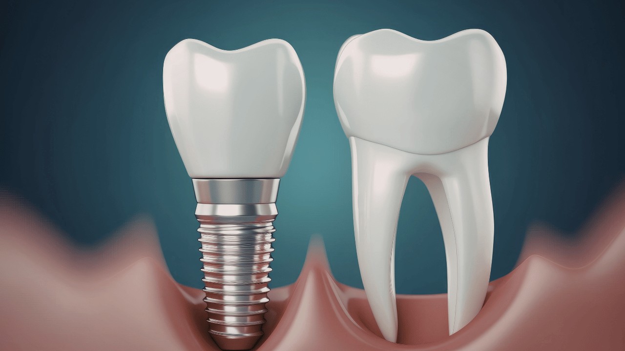 Best Dental Implants Treatment in Janakpuri