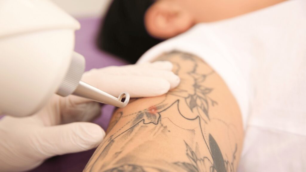 Tattoo Removal Treatment in Janakpuri