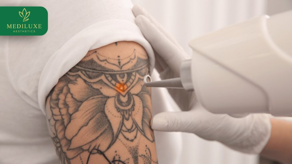 Tattoo Removal Treatment in Janakpuri