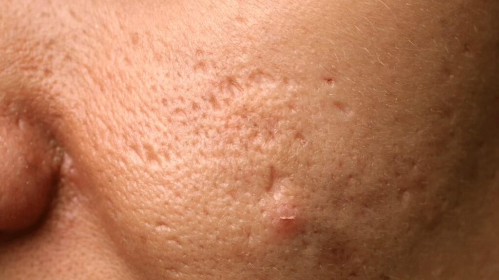 Acne & Acne Scar Treatment