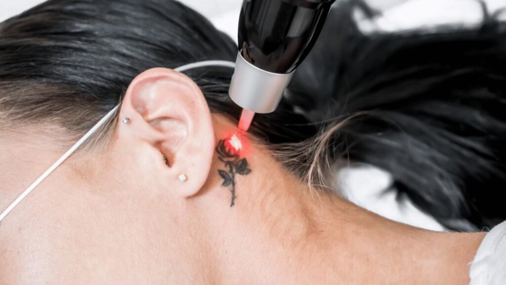 Tattoo Removal Treatment in Janakpuri