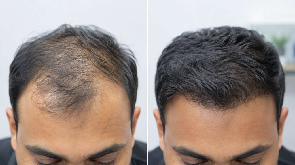PRP treatment for hair fall in Janakpuri