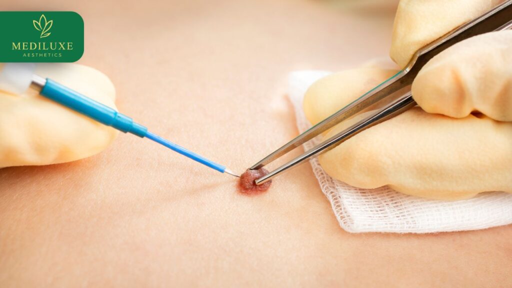 Mole Removal Gold Coast: What to Know Before Booking