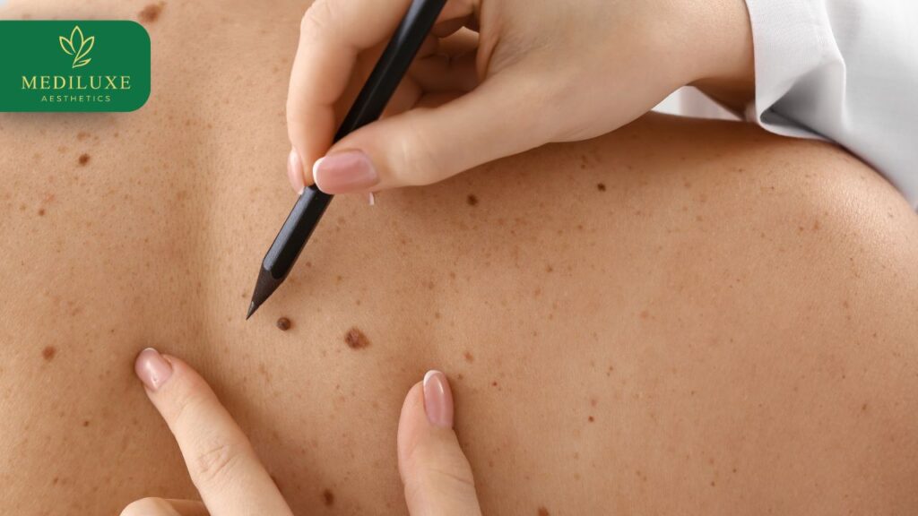 Laser mole removal consultation in a Gold Coast skin clinic