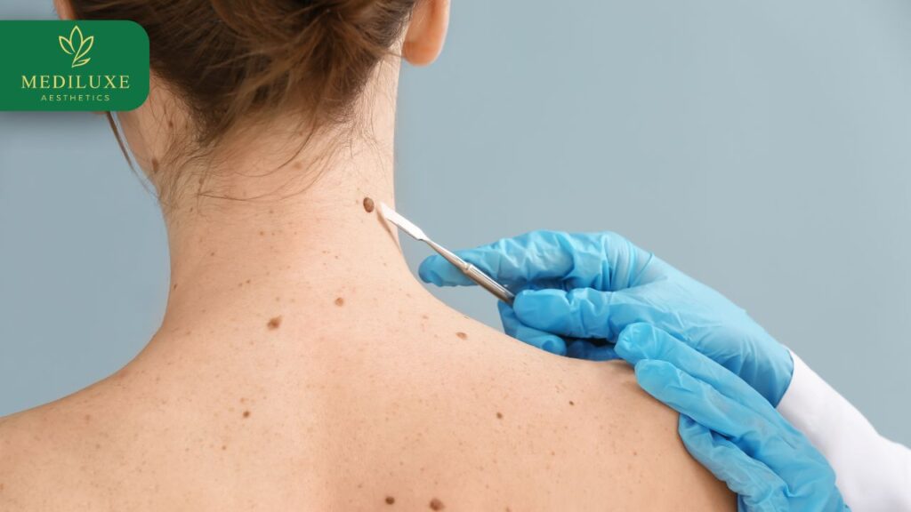 Patient receiving mole removal aftercare advice at Skin Age