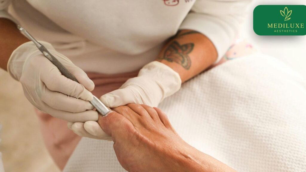 Fungal nail treatment consultation in a Nerang skin clinic