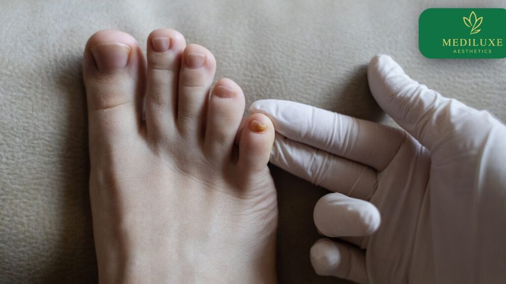 Epidermal lesion assessment at Skin Age Nerang