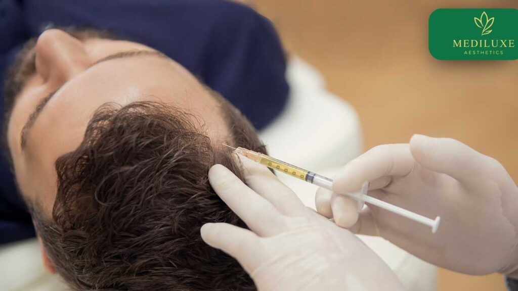 PRP scalp injection session at Mediluxe hair clinic, Janakpuri