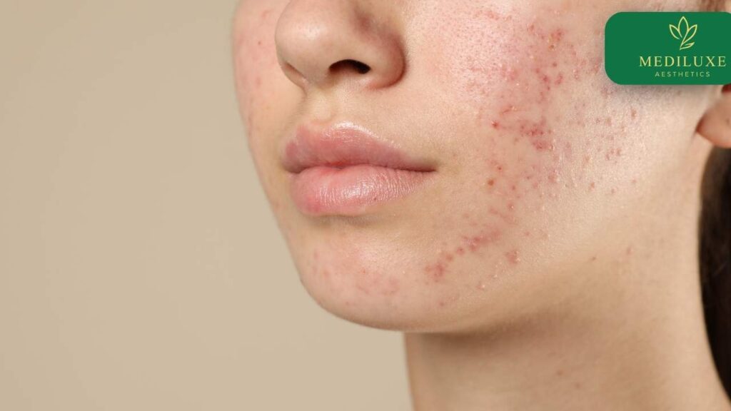 Visual guide to acne scar types relevant to Indian skin at Mediluxe
