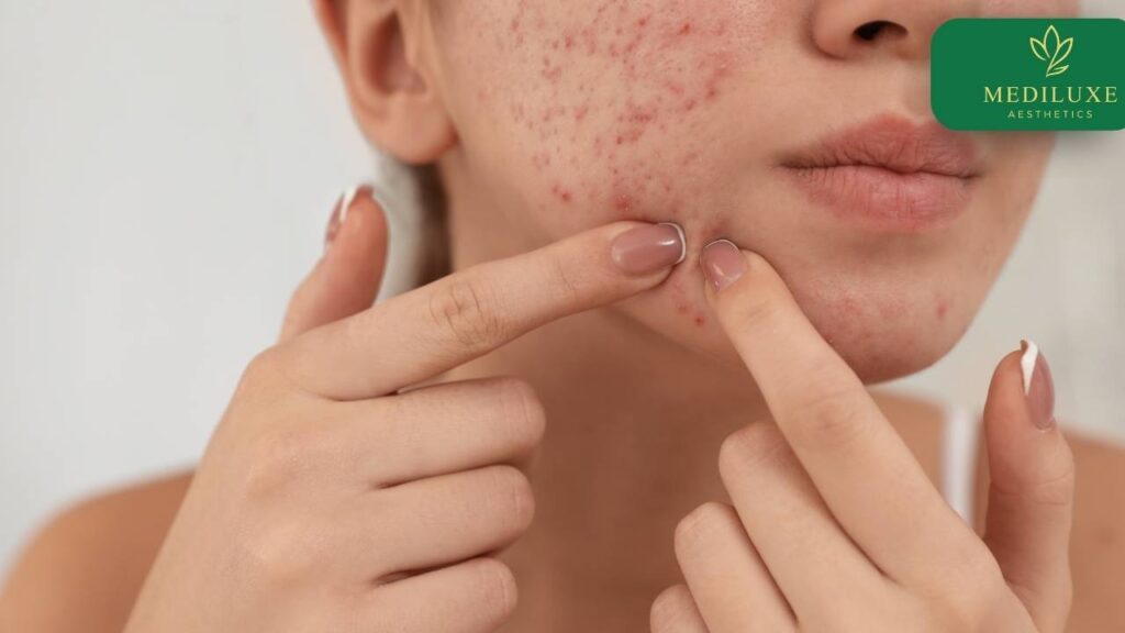 Acne scar treatment session at Mediluxe skin clinic, Janakpuri