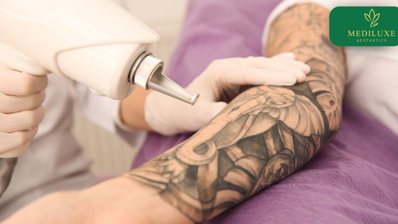 Does Tattoo Removal in Janakpuri Leave Scars Behind?