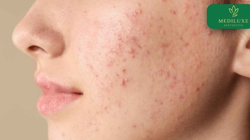 Dermatologist examining active acne before recommending a treatment sequence