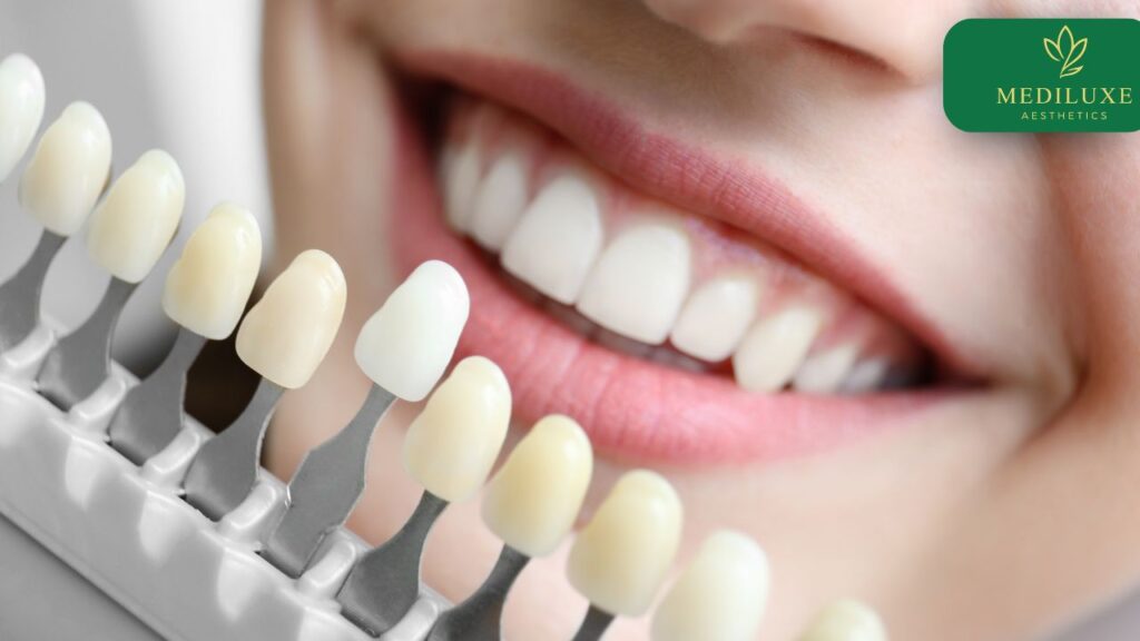 Teeth whitening consultation with Dr Simran Saxena at MediLuxe in Janakpuri