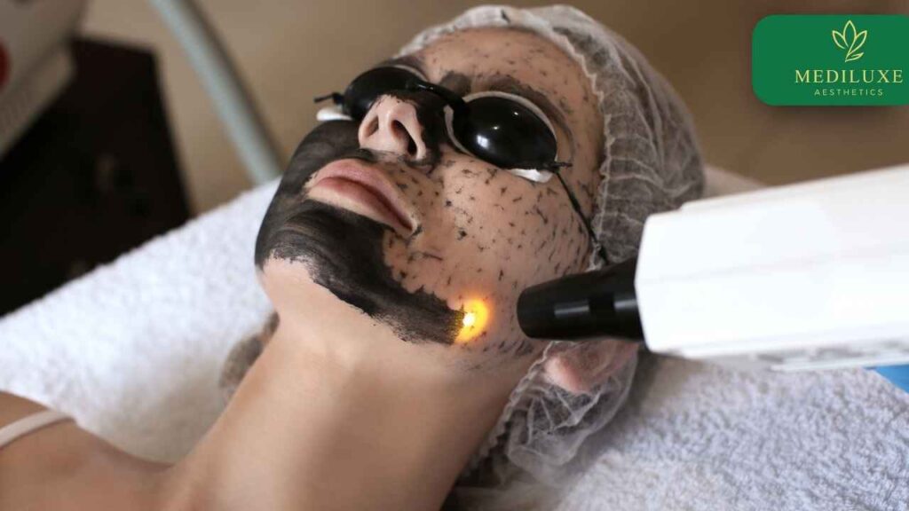 What Is a Carbon Laser Peel and Does It Actually Work?